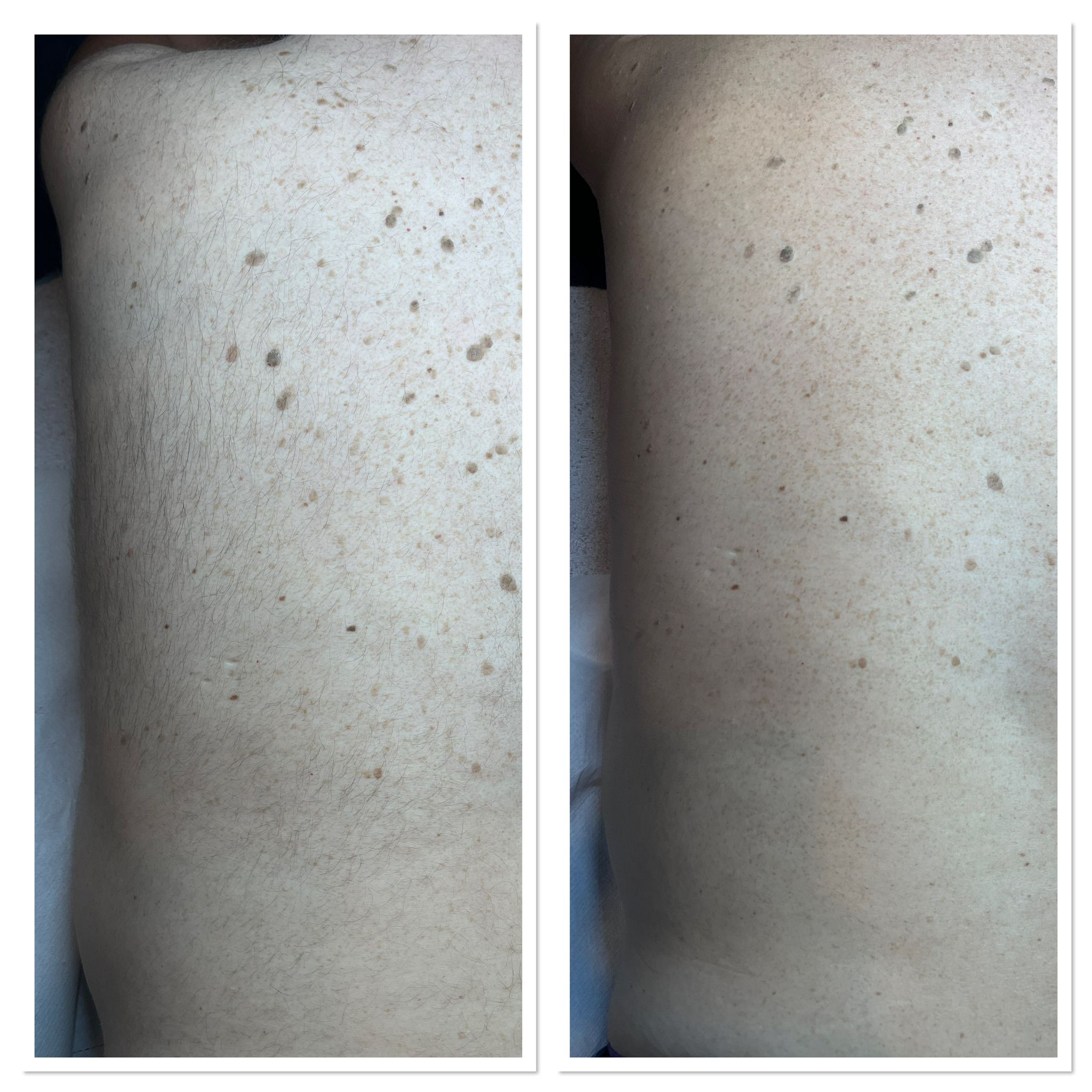 Resultaat laserontharing na 1 behandeling